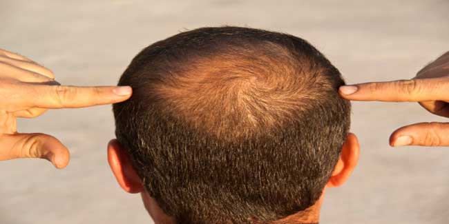 क्या गंजेपन के इलाज में उपयोगी है कैस्टर ऑयल